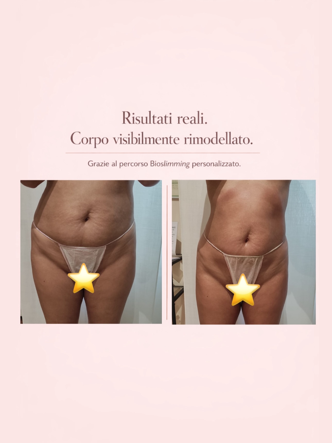 Risultato trattamento 5 – Vanità Estetic